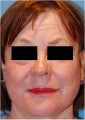 CO2 Laser Resurfacing ~ ActiveFX & DeepFX