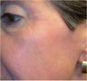 CO2 Laser Resurfacing ~ Active & DeepFX 