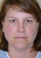 Active FX & Upper Eyelid Lift (Blepharoplasty)