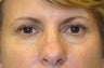 Active FX Laser Resurfacing