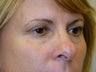 Active & Deep FX Laser Resurfacing