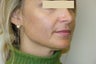 Active FX Laser Resurfacing