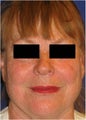 CO2 Laser Resurfacing ~ ActiveFX & DeepFX