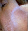 CO2 Laser Resurfacing ~ Active & DeepFX 