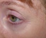 Affirm treatment of eye area wrinkles (crowsfeet)