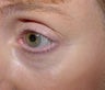 Affirm treatment of eye area wrinkles (crowsfeet)