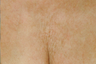 Affirm CO2 to Chest Area