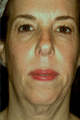 Affirm CO2 Laser