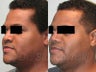 African American Rhinoplasty