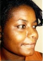 Rhinoplasty