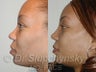 African American Rhinoplasty
