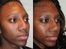 African American Rhinoplasty Revision