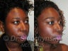 African American Rhinoplasty