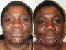 African American Rhinoplasty