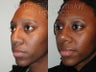 African American Rhinoplasty Revision