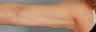Brachioplasty