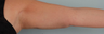 Brachioplasty/Liposuction