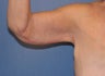 Brachioplasty