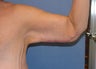 Brachioplasty