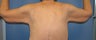 Brachioplasty