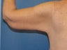 Brachioplasty
