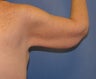 Brachioplasty