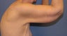 Brachioplasty