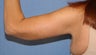 Brachioplasty