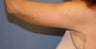 Brachioplasty