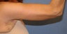 Brachioplasty