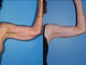 Brachioplasty - Upper Arm Lift