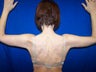 Arm Lift Surgery