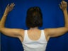 Arm Lift Surgery