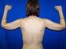 Arm Lift Surgery