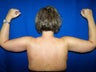 Arm Lift Surgery