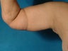 Arm Lift