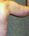 Arm Lift (Brachioplasty)