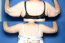Arm Lift