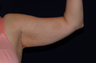 Arm Lift