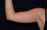 Arm Lift