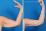 Arm Lift aka Brachioplasty
