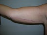 Arm Lift