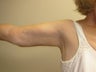 Brachioplasty