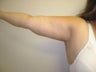 Arm Lift