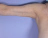 Arm Lift