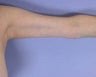 Arm Lift