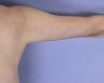 Arm Lift