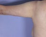 Arm Lift