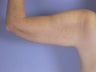 Arm Lift
