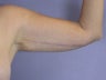 Arm Lift